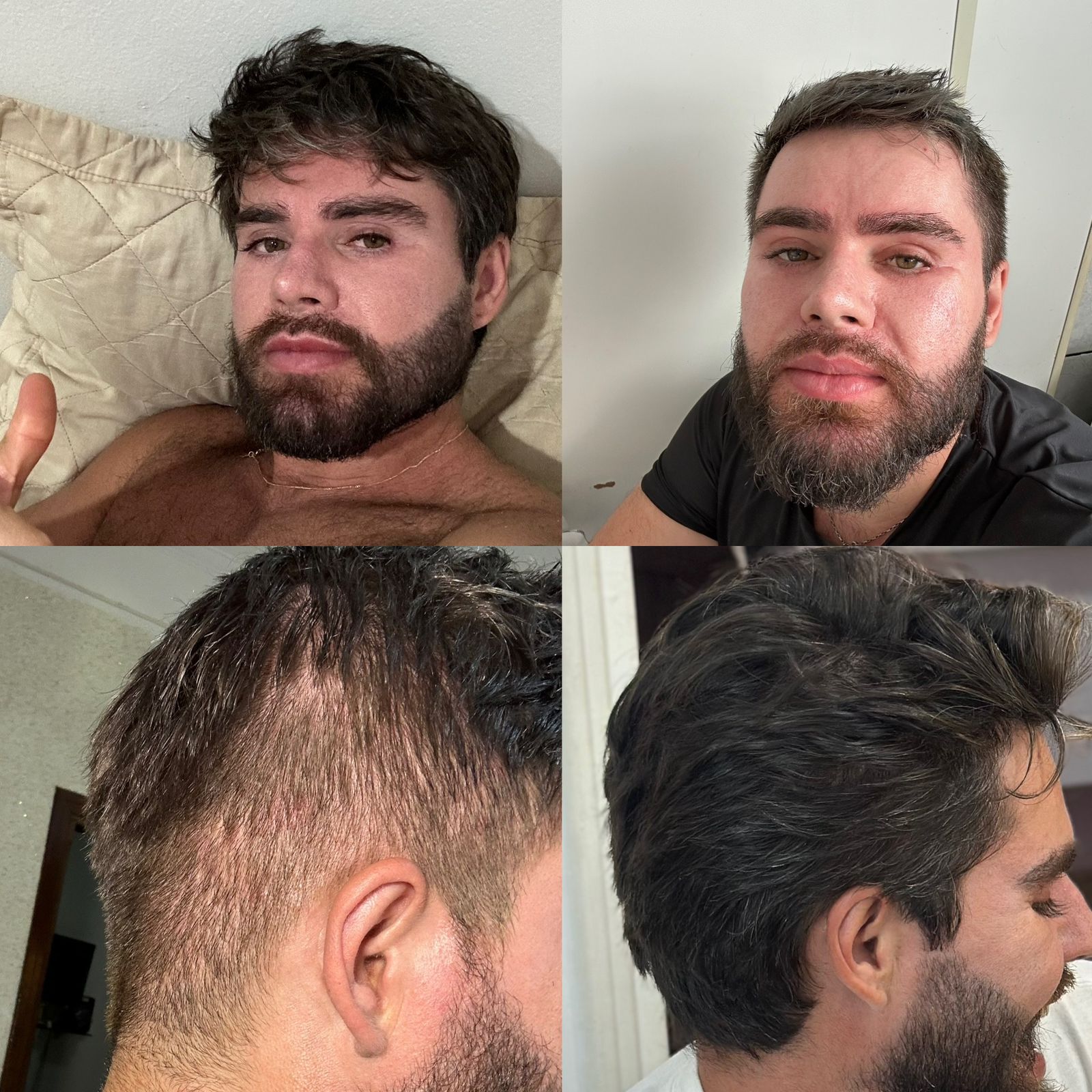 XÔ QUEDA CRESCIMENTO EXAGERADO